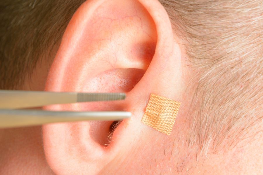 oreja de un paciente  y una pinza colocando un parche para sesión de auriculoterapia